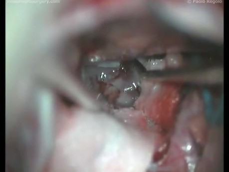 Clival Chordoma - Left Retrosigmoid Approach