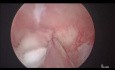 Removal of Endometrial Polyp - Polypectomy
