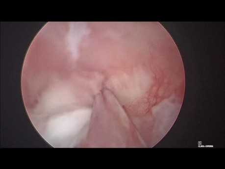 Removal of Endometrial Polyp - Polypectomy