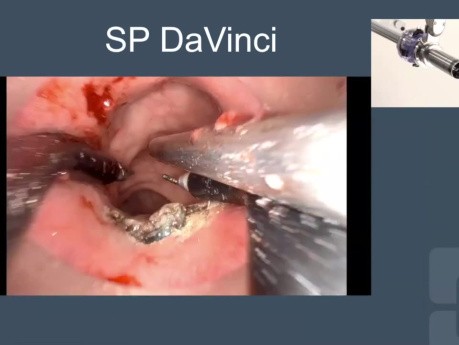 VF Master Class Rectal Cancer Management