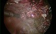 Infected Urachal Cyst with Umbilical Sinus