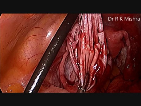 Laparoscopic Ovarian Cystectomy