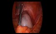 Laparoscopically Assisted Ovary Tumorectomy