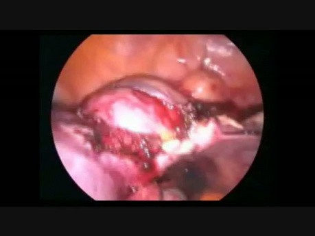 Laparoscopic Hysterectomy with Large Myoma