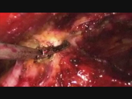 Laparoscopic TEP Umbilical Hernia Repair