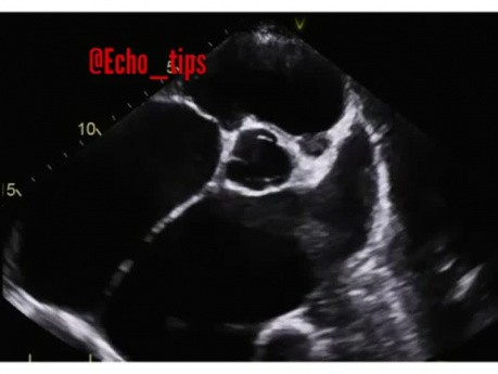 10. Echocardiography Case - What is the View, Structures and Finding?