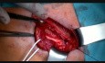 No Mesh Inguinal Hernia Repair - Direct Hernia - Desarda Repair