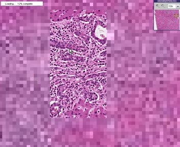 Acute And Chronic Cholangitis