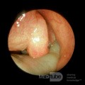 Numerous Nasal Polyps with Extension into the Choana