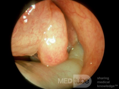 Numerous Nasal Polyps with Extension into the Choana
