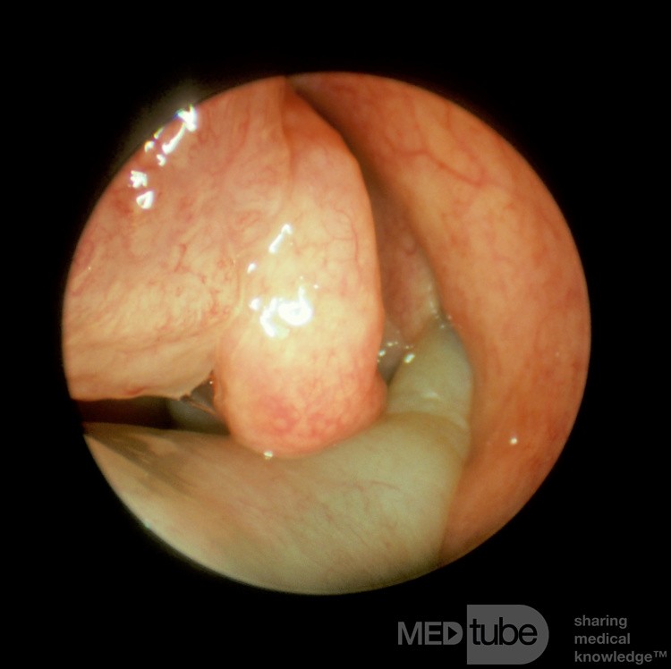 Numerous Nasal Polyps with Extension into the Choana