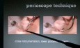 Technique of Perioscopy