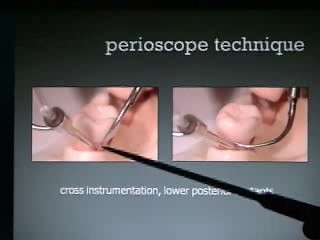Technique of Perioscopy