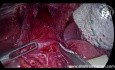 Redo Laparoscopic Heller's Cardiomyotomy for Recurrent Achalasia: Is Laparoscopic Surgery Feasible?