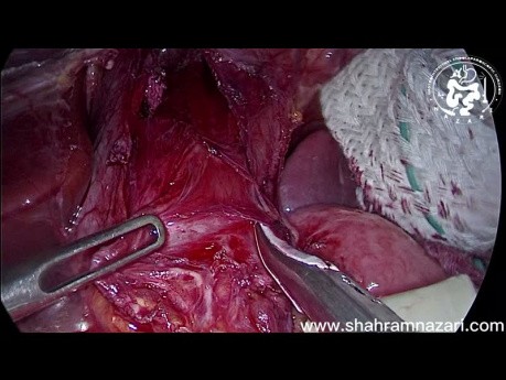Redo Laparoscopic Heller's Cardiomyotomy for Recurrent Achalasia: Is Laparoscopic Surgery Feasible?