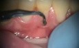 Poorly Fabricated Dental Fillings Correction