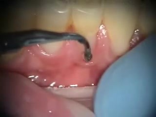 Poorly Fabricated Dental Fillings Correction