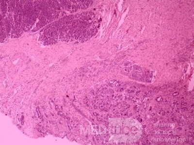 Cholangiocarcinoma that infiltrated a Periampullary Duodenal Diverticula and the head of the pancreas (19 of 20)