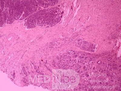 Cholangiocarcinoma that infiltrated a Periampullary Duodenal Diverticula and the head of the pancreas (19 of 20)