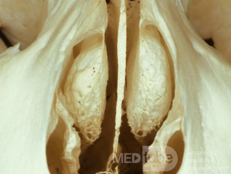 Bilateral Concha Bullosa [Osteological Specimen]