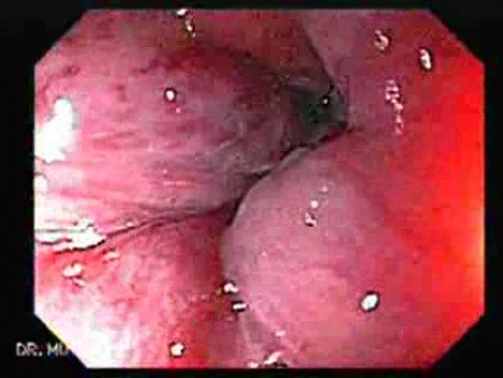 Prolapsed Hemorrhoid (4 of 4)