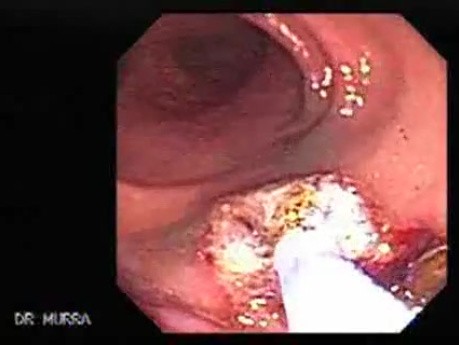 Cap polyposis that resemble a adenocarcinoma of the rectum (6 of 7)