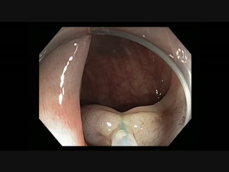 Colonoscopy - Sigmoid Colon Giant Polyp Resection - Epi-Loop-Cut-Clip