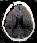 Acute Spontaneous Subdural Hemorrhage in the Subdural Space
