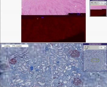 Kidney - Disseminated Intravascular Coagulation - Microthrombi - Microinfarcts