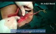 Surgery of Ectopic Pregnancy
