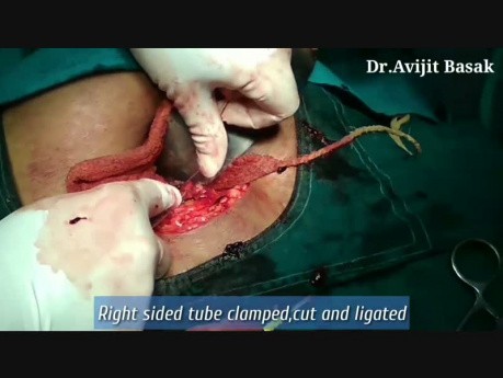 Surgery of Ectopic Pregnancy