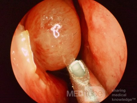 Nasal Polyp with Powered Suction Shaver