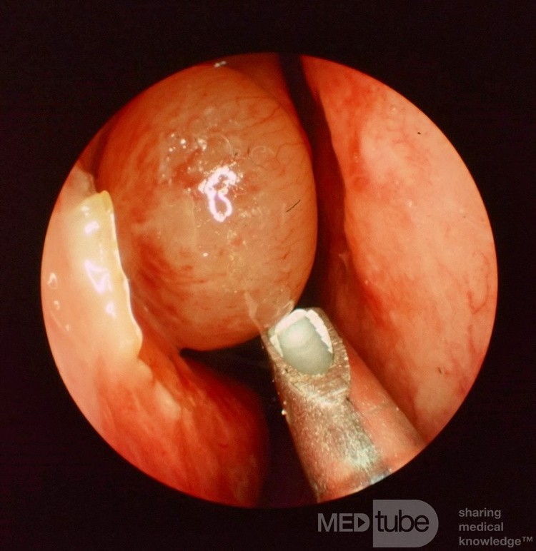 Nasal Polyp with Powered Suction Shaver