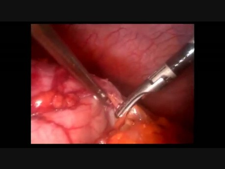 Gastric Tumor Minilaparoscopic