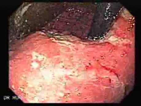 Synchronous Cancer (Gastric and Esophageal) - Extensive Infiltration of the Fundus and Body