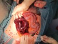 Mesenterial Venous Thrombosis