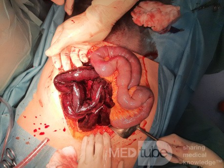 Mesenterial Venous Thrombosis