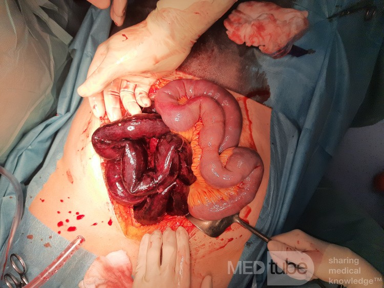 Mesenterial Venous Thrombosis