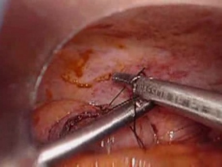 Colonic Perforation With Peritonitis - Laparoscopy (12 of 46)