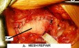 Open Mesh Repair Of Inguinal Hernia - Intra-Operative Photo