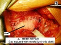 Open Mesh Repair Of Inguinal Hernia - Intra-Operative Photo