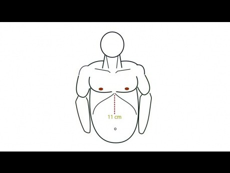 Geometry Fundoplication App Tutorial, Chapter 03 Operating Room SetUp and Placement of the Trocars