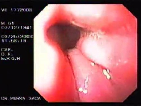 Banding of esophageal varices (10 of 17)