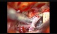 Brain Aneurysm - Internal Carotid Artery Bifurcation Aneurysm