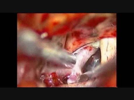 Brain Aneurysm - Internal Carotid Artery Bifurcation Aneurysm