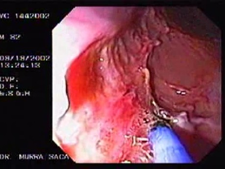 Rectal Trauma (1 of 2)