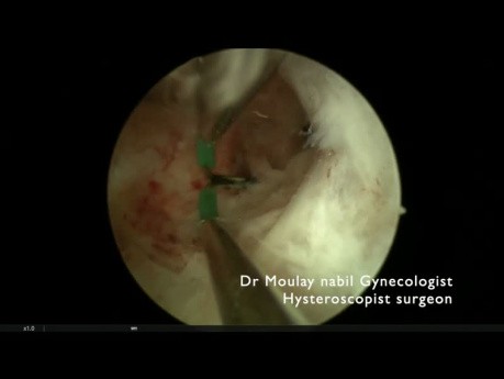 Metroplasty after Genital Tuberculosis with the  "Resecare * "