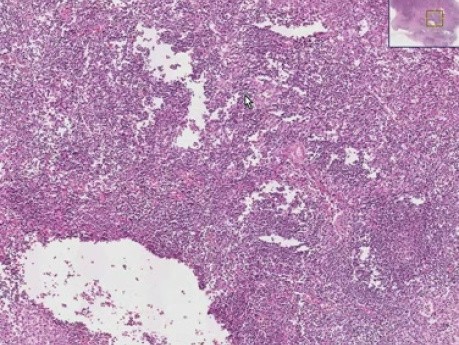 Metastatic breast carcinoma - Histopathology - Lymph node