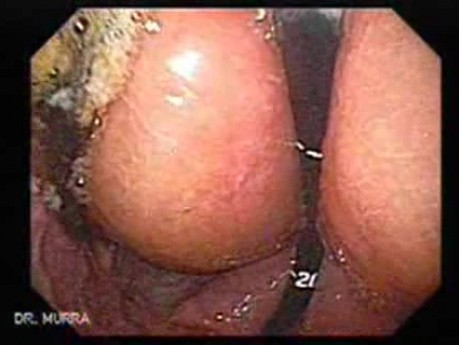 Abdominal Compartment Syndrome due to Malignancy (2 of 10)