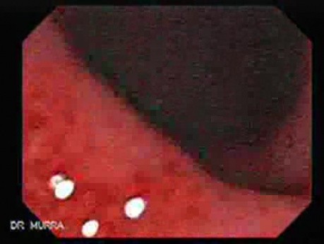 Ulcerative Colitis - Endoscopy (4 of 5)